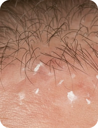 지루성 두피염/각질